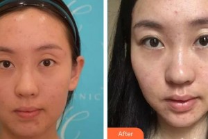 郴州曹家易麗醫(yī)療美容門診部覃翠蘭整形價格表附清潔祛痘案例展示