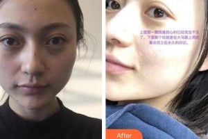 郴州曹家易麗醫(yī)療美容門診部詹慧整形價格表附激光點痣案例展示