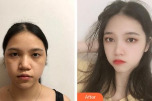 郴州曹家易麗醫(yī)療美容門診部李曉東整形價格表附去痘印痘坑案例展示