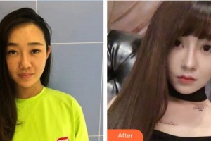 郴州維納斯醫(yī)療美容醫(yī)院黃致遠整形價格表附無針水光案例展示