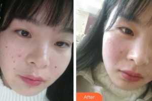 郴州瑞瀾醫(yī)療美容醫(yī)院余涵整形價格表附清潔祛痘案例展示