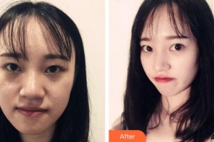 郴州市第一人民醫(yī)院整形美容科李石峰整形價格表附肋軟骨隆鼻案例展示