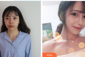 郴州市第四人民醫(yī)院沈斌整形價格表附鼻修復(fù)例展示