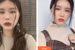 郴州市第四人民醫(yī)院王暉整形價格表附鼻小柱延長案例展示