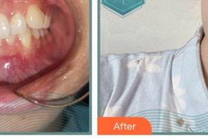 郴州冠華口腔醫(yī)院駱定安整形價格表附金屬托槽矯正案例展示