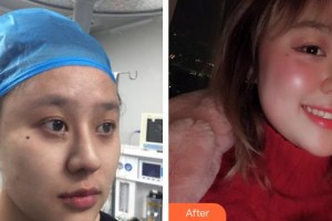 南方醫(yī)院整形美容科馮傳波整形價(jià)格表附埋線(xiàn)提升案例展示