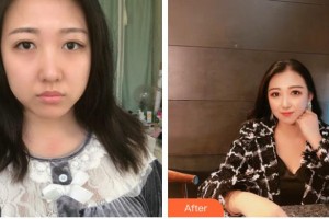 南方醫(yī)院整形美容科張立憲整形價(jià)格表附埋線(xiàn)提升案例展示