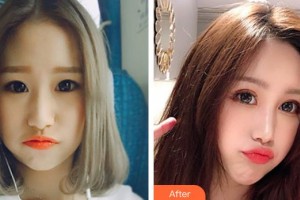 南方醫(yī)院整形美容科劉曉軍整形價(jià)格表附射頻緊膚案例展示