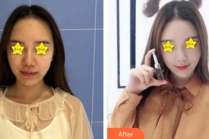 南方醫(yī)院整形美容科溫公佳住院醫(yī)師整形價(jià)格表附埋線(xiàn)提升案例展示