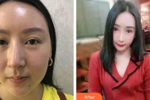 南方醫(yī)院整形美容科黎小間整形價(jià)格表附埋線(xiàn)提升案例展示