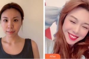 南方醫(yī)院整形美容科楊澄宇住院醫(yī)師整形價格表附埋線提升案例展示