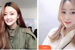 南方醫(yī)院整形美容科胡振富整形價(jià)格表附埋線(xiàn)提升案例展示