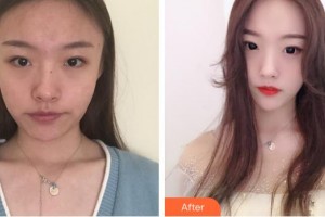 南方醫(yī)院整形美容科魯峰整形價(jià)格表附埋線(xiàn)提升案例展示