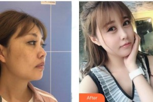 南方醫(yī)院整形美容科羅勇整形價(jià)格表附埋線(xiàn)提升案例展示