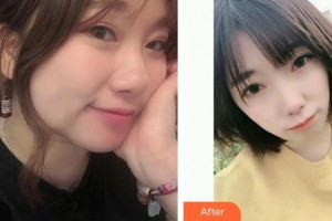 南方醫(yī)院整形美容科胡志奇整形價(jià)格表附熱拉提案例展示