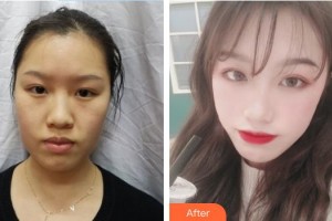 白求恩國(guó)際和平醫(yī)院整形美容中心楊建民整形價(jià)格表附埋線(xiàn)提升案例展示