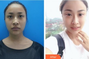 白求恩國(guó)際和平醫(yī)院整形美容中心張軼整形價(jià)格表附埋線(xiàn)提升案例展示