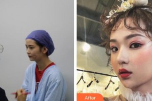 白求恩國(guó)際和平醫(yī)院整形美容中心安亮恩整形價(jià)格表附埋線(xiàn)提升案例展示