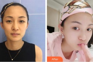 白求恩國(guó)際和平醫(yī)院整形美容中心王配合整形價(jià)格表附埋線(xiàn)提升案例展示