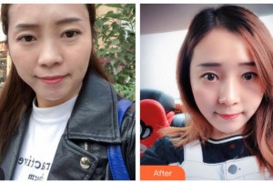 樂清華山中西醫(yī)結(jié)合醫(yī)院醫(yī)學(xué)整形美容中心蔣伯熙整形價(jià)格表附黃金微針案例展示