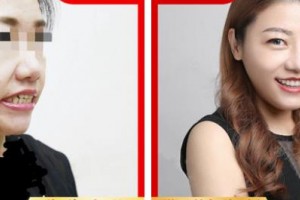 樂(lè)清牙科醫(yī)院許紅整形價(jià)格表附牙齒隱形矯正案例展示