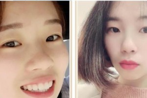 樂(lè)清牙科醫(yī)院徐鵬整形價(jià)格表附牙齒陶瓷矯正案例展示