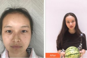 樂清開發(fā)區(qū)醫(yī)院眼科王澤整形價(jià)格表附眼部綜合案例展示