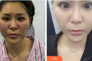 暨南大學(xué)附屬第一醫(yī)院整形美容激光中心李康英  整形價(jià)格表附牙齒陶瓷矯正案例展示