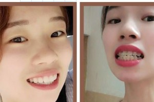 暨南大學(xué)附屬第一醫(yī)院整形美容激光中心劉宏偉  整形價格表附冷光美白案例展示