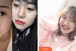 八大處整形醫(yī)院國貿(mào)門診部呂唯整形價格表附牙齒隱形矯正案例展示