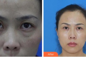 永康康利眼科醫(yī)院王曉鵬整形價格表附切開雙眼皮案例展示