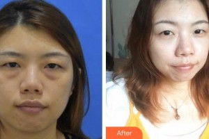 永康東方醫(yī)療美容診所陳倩倩整形價格表附切開雙眼皮案例展示
