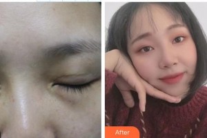 永康常春藤醫(yī)療美容診所陳珺怡整形價格表附眼部修復(fù)案例展示