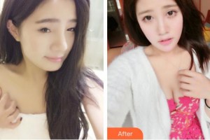 永康康利眼科醫(yī)院潘瑞整形價格表附切開雙眼皮案例展示