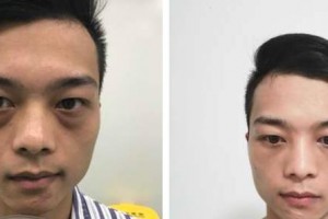 永康康利眼科醫(yī)院余野整形價格表附激光去眼袋案例展示