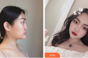 清遠市人民醫(yī)院整形美容科唐夏住院醫(yī)師整形價格表附耳軟骨復(fù)合隆鼻案例展示