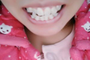 南昌輝煌口腔醫(yī)院彭凡牙齒矯正+圖片對(duì)比|較新價(jià)格表