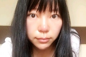 長(zhǎng)春西之米林鐘學(xué)隆胸手術(shù)附果圖+案例分享