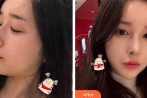 南華大學(xué)附屬第二醫(yī)院醫(yī)療美容科楊鋒整形價格表附鼻骨矯正案例展示