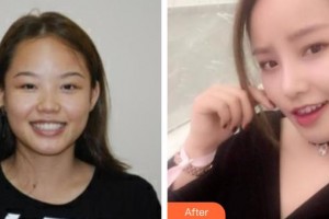 南華大學(xué)附屬第二醫(yī)院醫(yī)療美容科曾健整形價格表附鼻部綜合案例展示