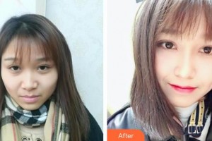 南華大學(xué)附屬第二醫(yī)院醫(yī)療美容科劉志坤整形價格表附鼻部綜合案例展示