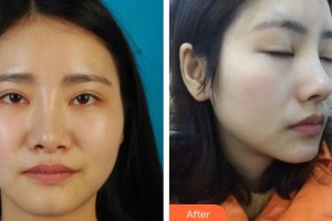 佛山瑞芙臣夢露醫(yī)學(xué)整形美容醫(yī)院孫增勤整形價格表附鼻部綜合案例展示