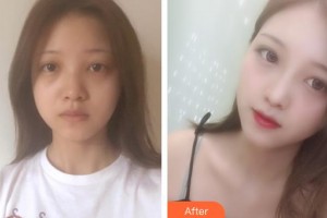 佛山華廈眼科醫(yī)院劉祖國整形價格表附眼部整形雙眼皮案例展示