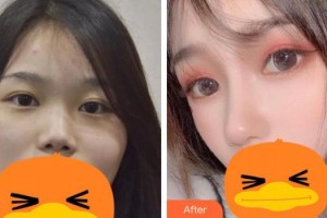 佛山華廈眼科醫(yī)院趙剛平整形價格表附激光去眼袋案例展示