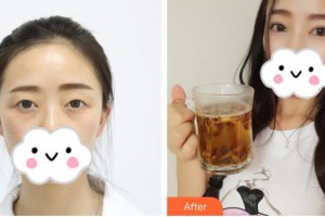 佛山華廈眼科醫(yī)院張廣斌整形價格表附切開雙眼皮案例展示