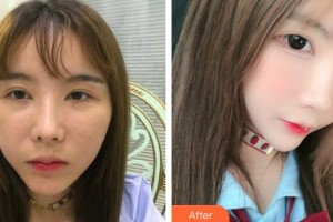 佛山華廈眼科醫(yī)院王騫整形價格表附眼部整形下眼下至術(shù)案例展示