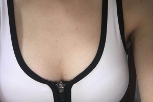 鄭州大學(xué)附屬醫(yī)院整形外科口碑好不好陳言湯隆胸案例附價(jià)格一覽