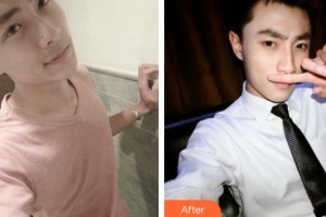 武夷山麗姿醫(yī)療美容醫(yī)院樸炳春整形價格表附鼻部綜合案例展示