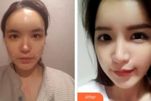 皖北煤電集團總醫(yī)院醫(yī)學美容中心楊州整形價格表附鼻部綜合案例展示