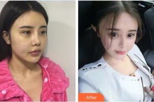 皖北煤電集團總醫(yī)院醫(yī)學美容中心錢國慶整形價格表附鼻部綜合案例展示